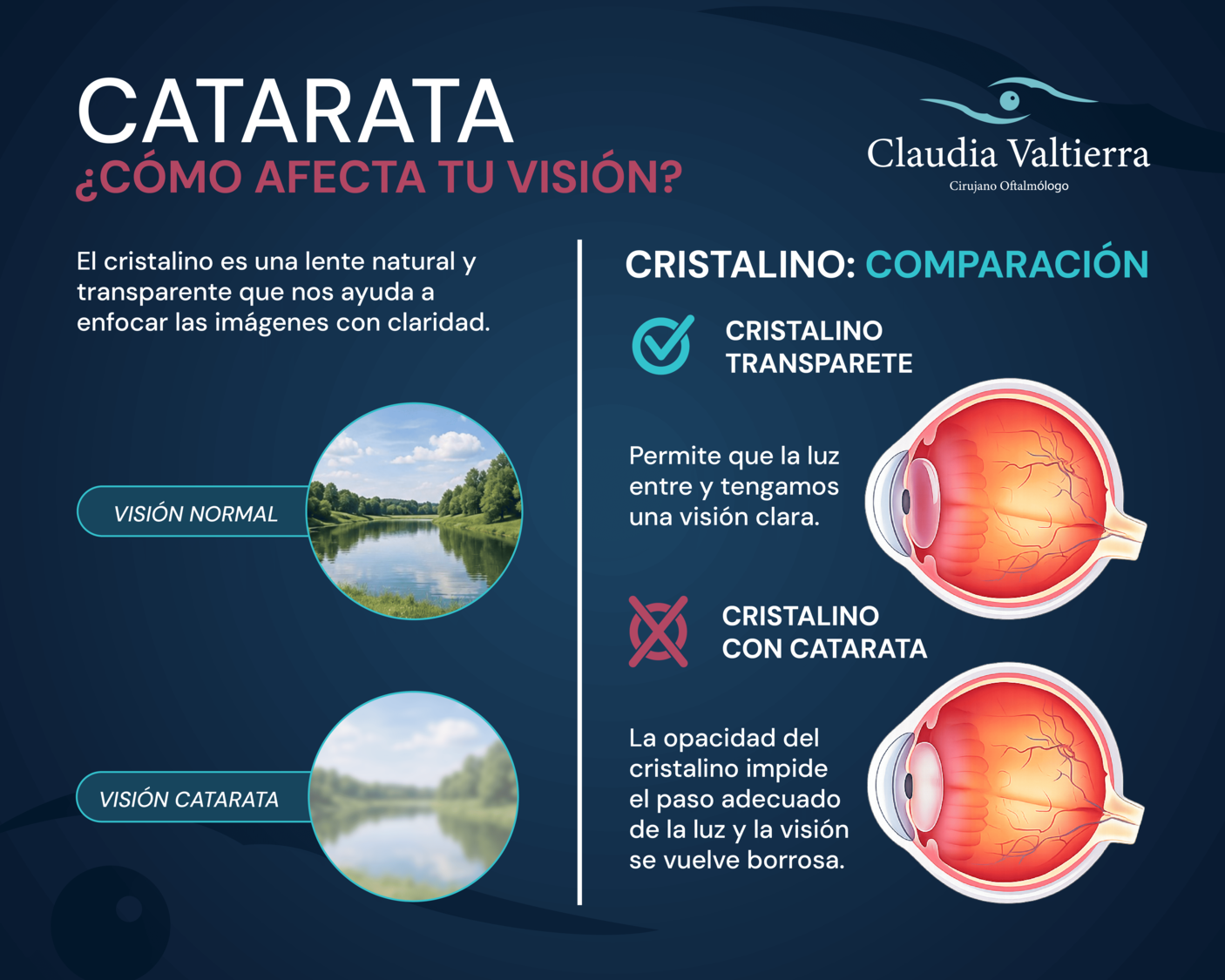 Catarata: primeros síntomas que no debes ignorar